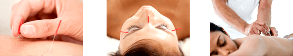 Duluth Acupuncture Benfits