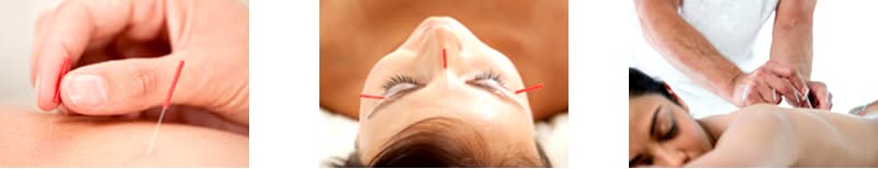 Duluth Acupuncture Benfits